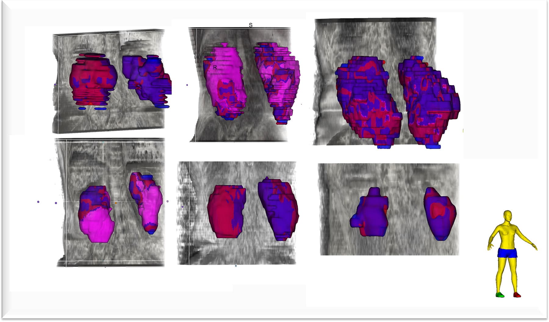 Deployed Deep Learning Kidney Segmentation for ADPKD Disease MRI